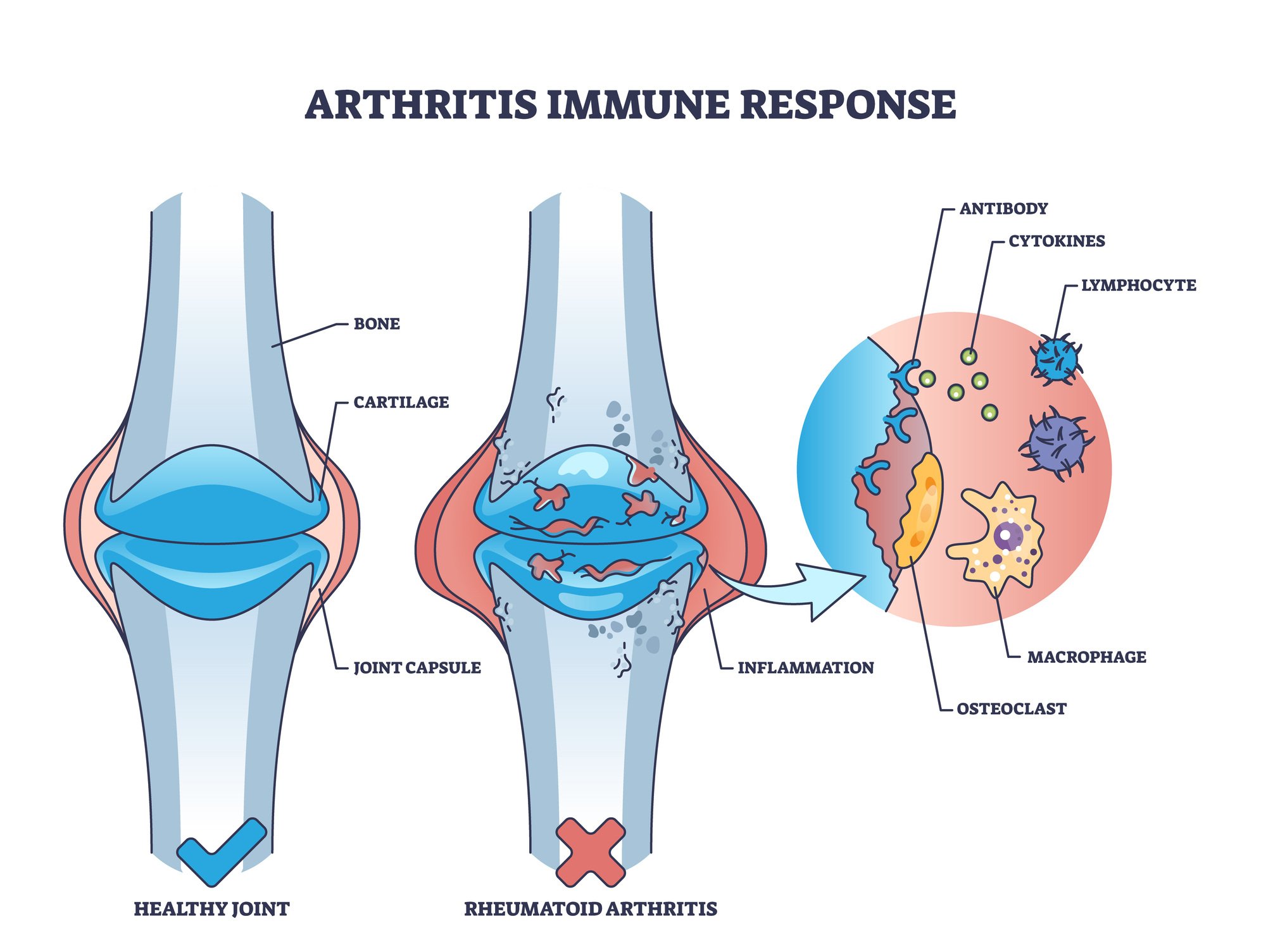 Why Women Are More Susceptible to Autoimmune Diseases